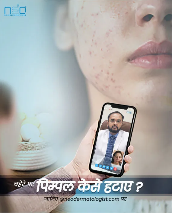 pimple kaise hataye , पिम्पल हटाने का तरीका, pimple ke daag kaise hataye ,  face pe dane kaise hataye , पिंपल कैसे हटाए  ,  chehre pe pimple kaise hataye ,  pimple ke kale daag kaise hataye ,   pimple hatane ke upay, pimple how to remove,pimple ko kaise h