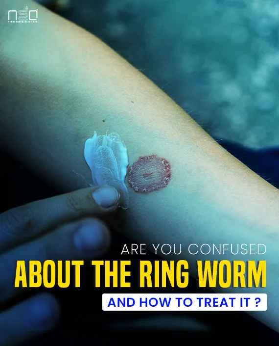 ringworm how to treat, ring worm cream, ringworm infection treatment, ringworm how to cure, ringworm treatment at home, treatment of ring worm infection, दाद का इलाज, दादर, दाद खुजली की ट्यूब, भयंकर दाद खाज की दवा tablet 