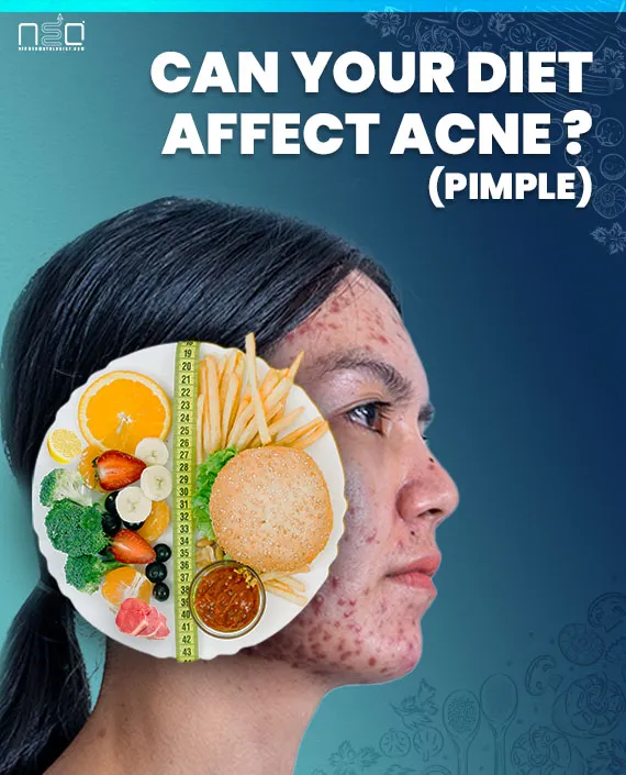 pimple causing foods, pimple after eating mango, pimple removing foods , पिम्पल होने पर क्या खाना चाहिए, पिम्पल होने पर क्या नहीं खाना चाहिए, संतुलित भोजन, मुंहासे, मुंहासों से छुटकारा, कील मुंहासे की आयुर्वेदिक दवा