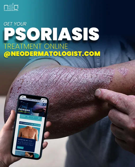 psoriasis treatment