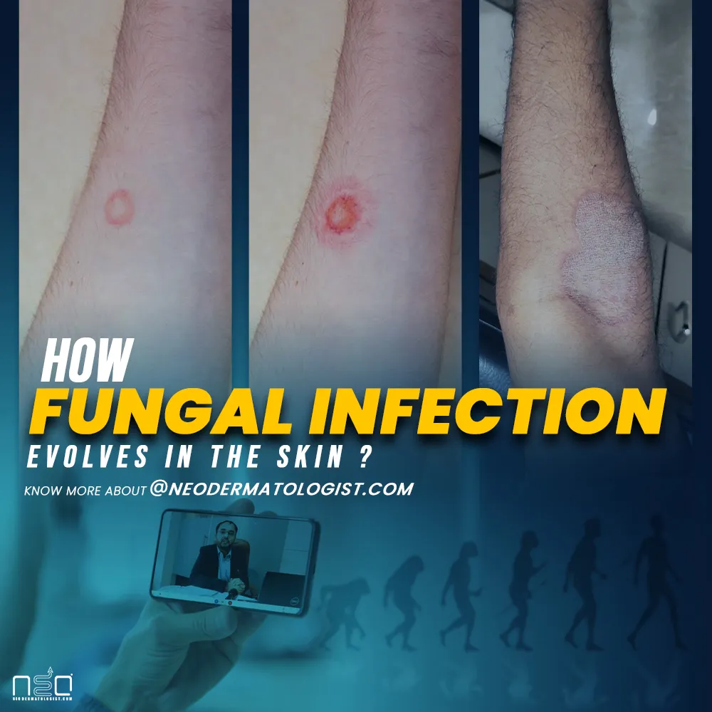 ringworm symptoms ,  ringworm on skin ,   jock itch rash , ringworm stages , ringworm disease , ringworm symptoms in humans , ringworm disease symptoms 