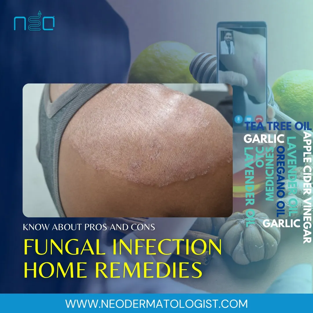 scalp fungal infection home remedies, nail fungal infection home remedies, fungal skin infection home remedies, fungal infection home remedies, ringworm infection home remedies, ringworm infection treatment at home, ringworm treatment at home, ringworm tr