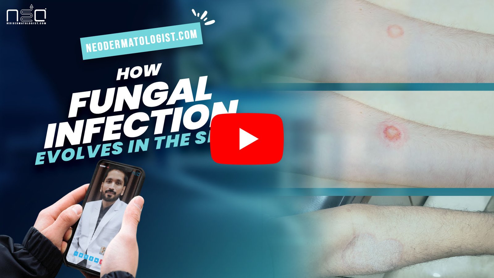 how fungal infection evolves in the skin