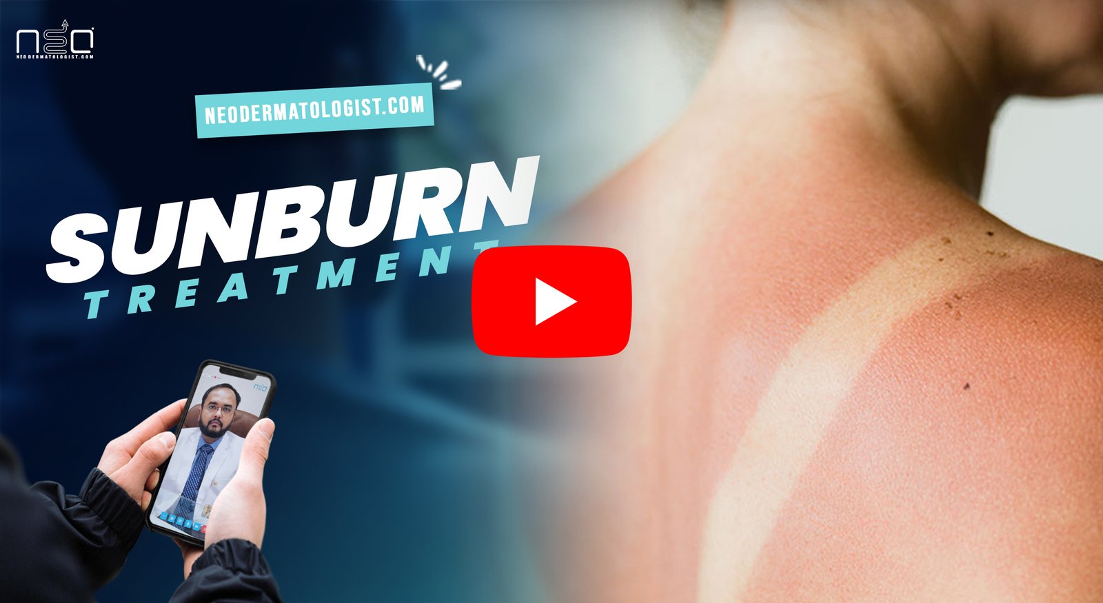 Sunburn Treatment, acne treatment online , best acne treatment online , online hair consultation , dermatologist consultation online , online dermatologist , trichologist , acne treatment , hair fall treatment , eczema treatment , psoriasis treatment ,vit